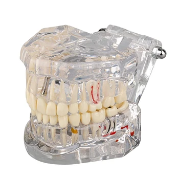 Цельнокроеная Прозрачная модель больных зубов с мостовидным протезом, прозрачный пластик для обучения пациентов и студентов-стоматологов